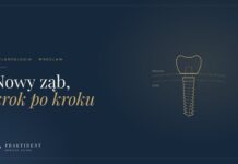 Implant zęba krok po kroku. Jak wygląda leczenie, zanim pojawi się nowy ząb alt: Implant zęba z koroną – ilustracja etapów leczenia implantologicznego