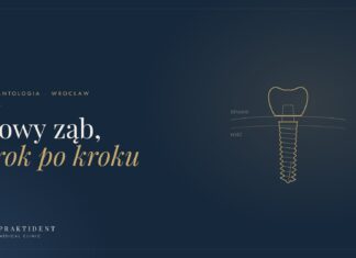 Implant zęba krok po kroku. Jak wygląda leczenie, zanim pojawi się nowy ząb alt: Implant zęba z koroną – ilustracja etapów leczenia implantologicznego