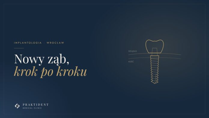 Implant zęba z koroną – ilustracja etapów leczenia implantologicznego alt: Implant zęba z koroną – ilustracja etapów leczenia implantologicznego