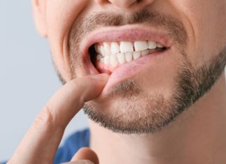 Krwawiące dziąsła? Nie lekceważ tego objawu!